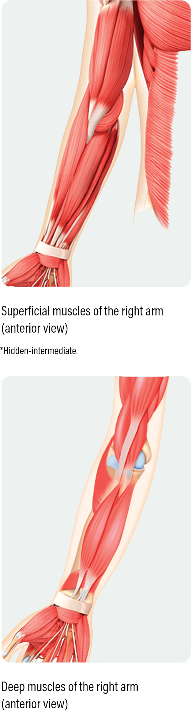 medical diagram with an anterior view showing how to dose and administer dysport for superficial muscles of the right arm in pediatric upper limb spasticity